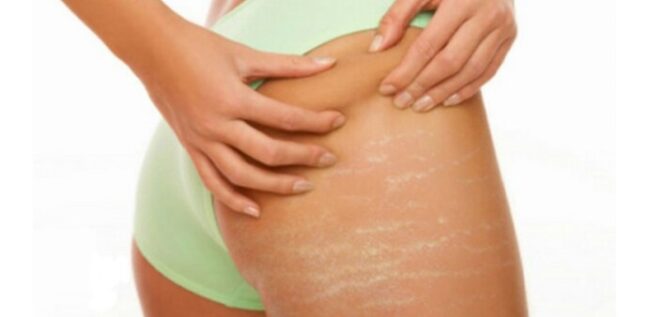 
					Tips Menghilangkan Strecth Mark yang Harus Kamu Coba