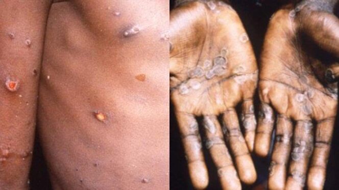 
Indonesia Waspada Virus Cacar Monyet Menular