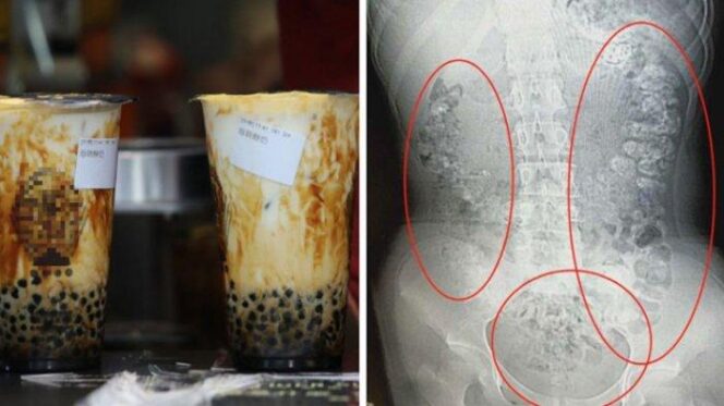 
					Tak Bisa Buang Air Besar Akibat Bubble Tea Bersarang di Perut